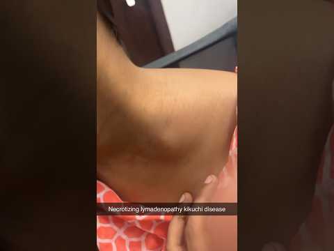 Rare disease kikuchi disease #lupus #sle #lymphnodes #necrosis #neck #migrating lymph node #doctor