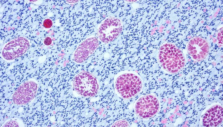 Revolutionizing Melanoma Treatment: OBX-115 Emerges as a Game-Changer in Cancer Therapy