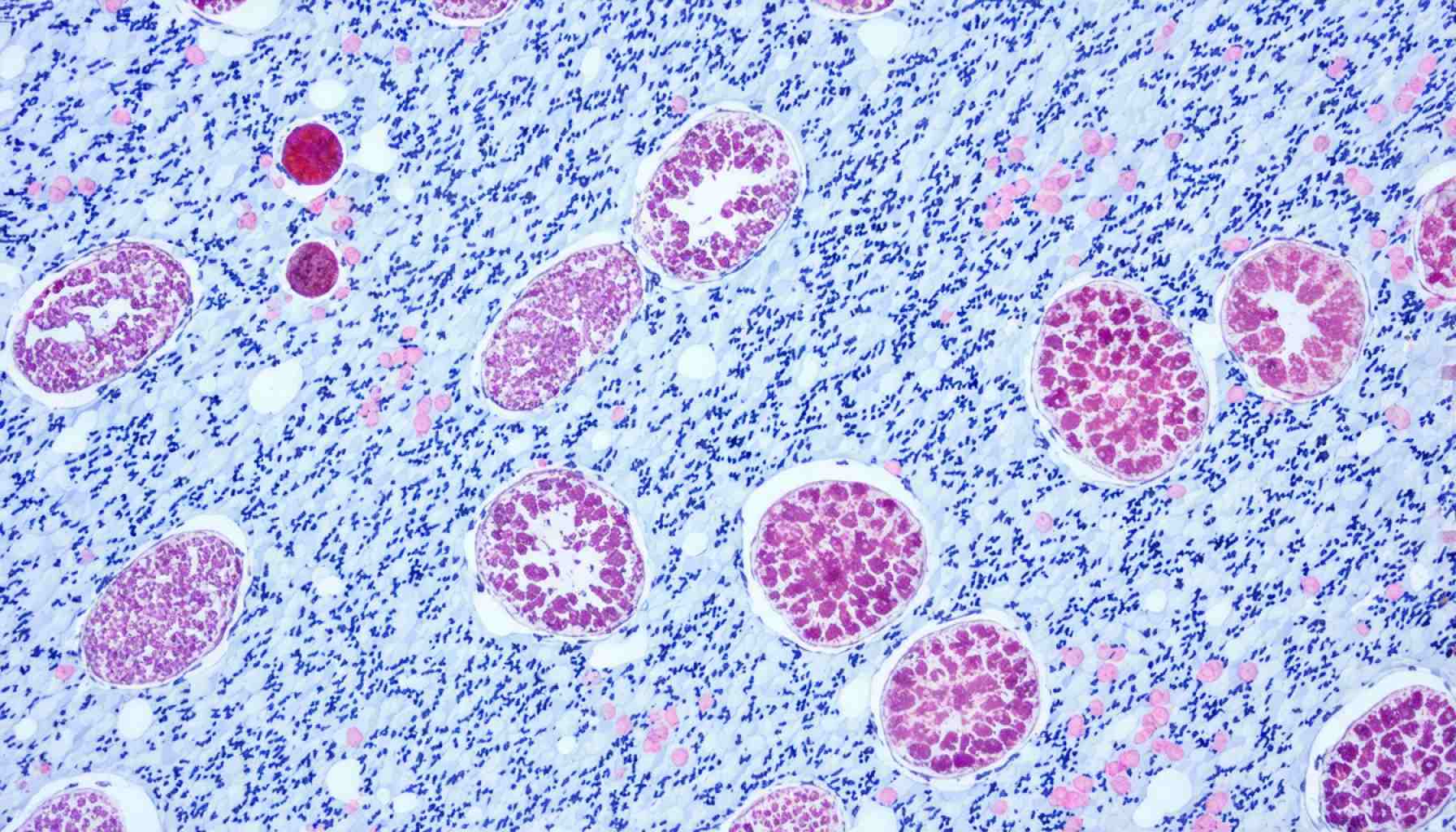 Revolucija u liječenju melanoma: OBX-115 se pojavljuje kao promjena igre u terapiji raka 